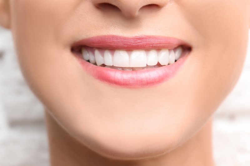 A smile with dental bonding that has been whitened and the bonding replaced