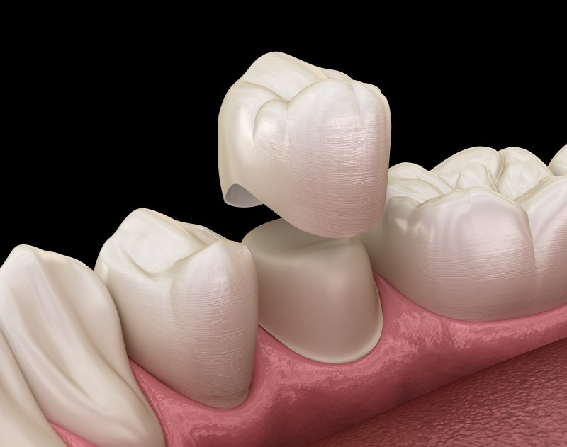A picture of how a dental crown is placed